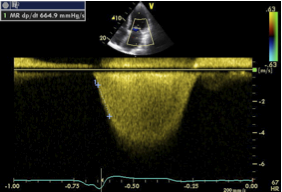 Lv Dp Dt Normal Values Iucn Water